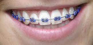 light purple braces