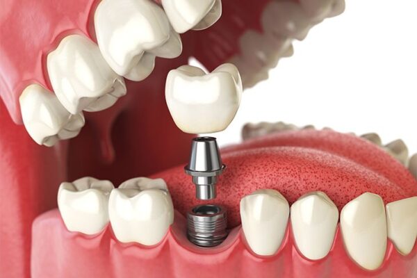 dental implants aberdeen