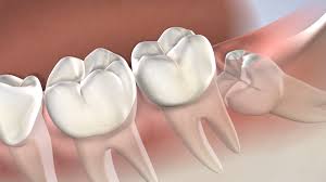 wisdom Tooth Extraction in dubai