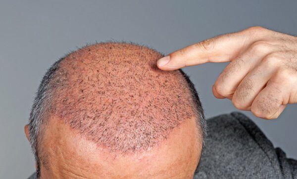 Hair Transplant Cost