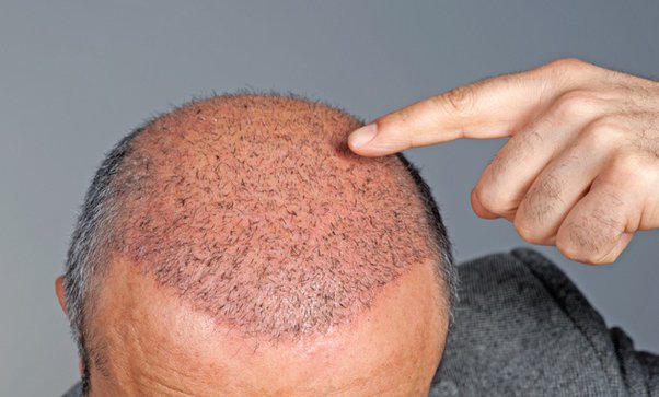 Hair Transplant Cost