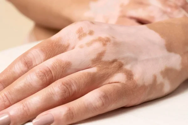 vitiligo hands