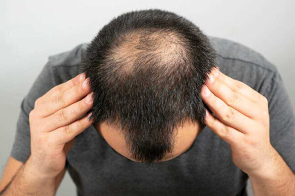 Is a Hair Transplant in Dubai the Best Solution for Hair Loss?