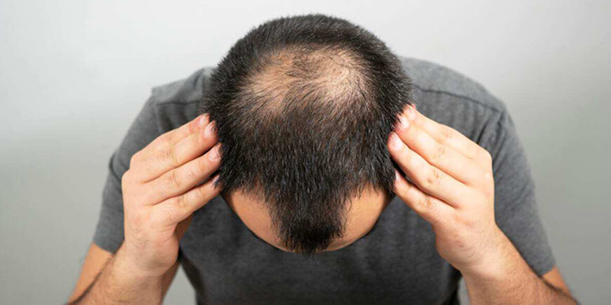 Is a Hair Transplant in Dubai the Best Solution for Hair Loss?