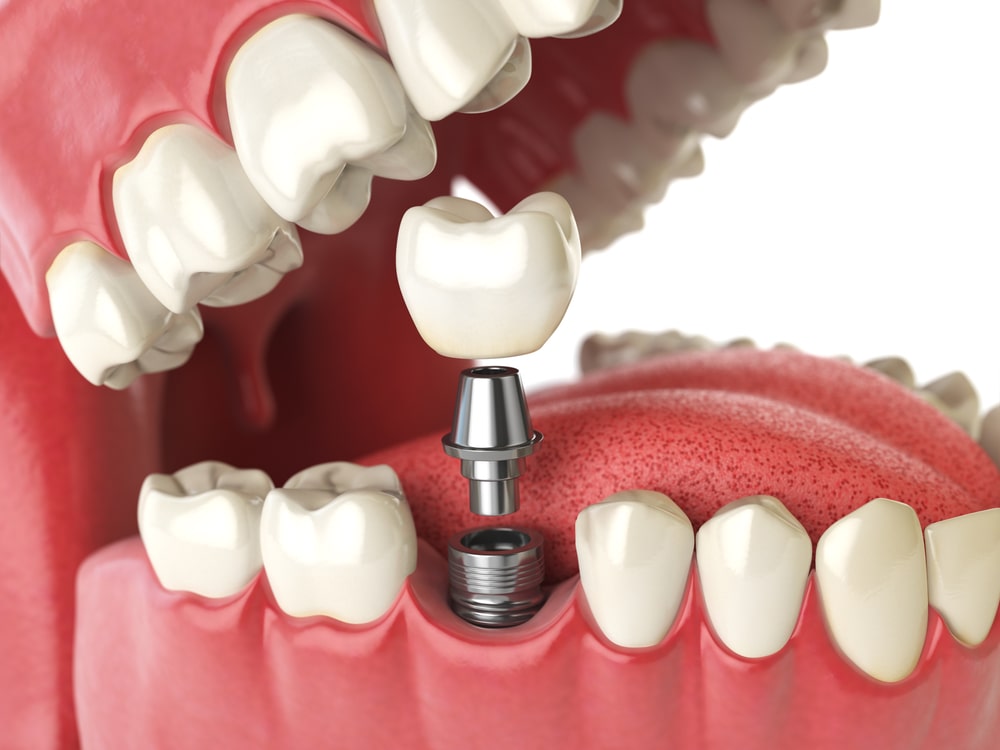 low cost dental implants uk